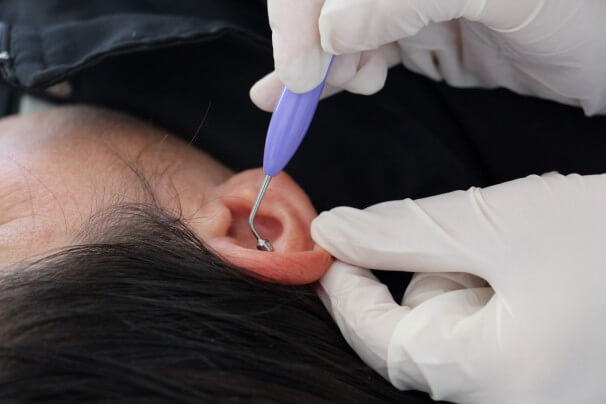 auriculoterapia2 (Large)